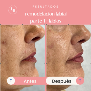 Aplicación de ácido hialurónico en labios para un efecto voluminoso.