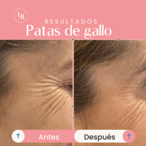 Es un ejemplo de un caso de antes y después de tratamiento de medicina estetica en Oviedo en donde se trataron las patas de gallo con botox o neuromoduladores