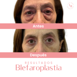 Caso de blefaroplastia antes/después realizado por las cirujanas Diaja La Jara y Cristina Burgos