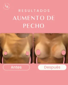 Aumento de pecho en mujer jóven. Antes y Después