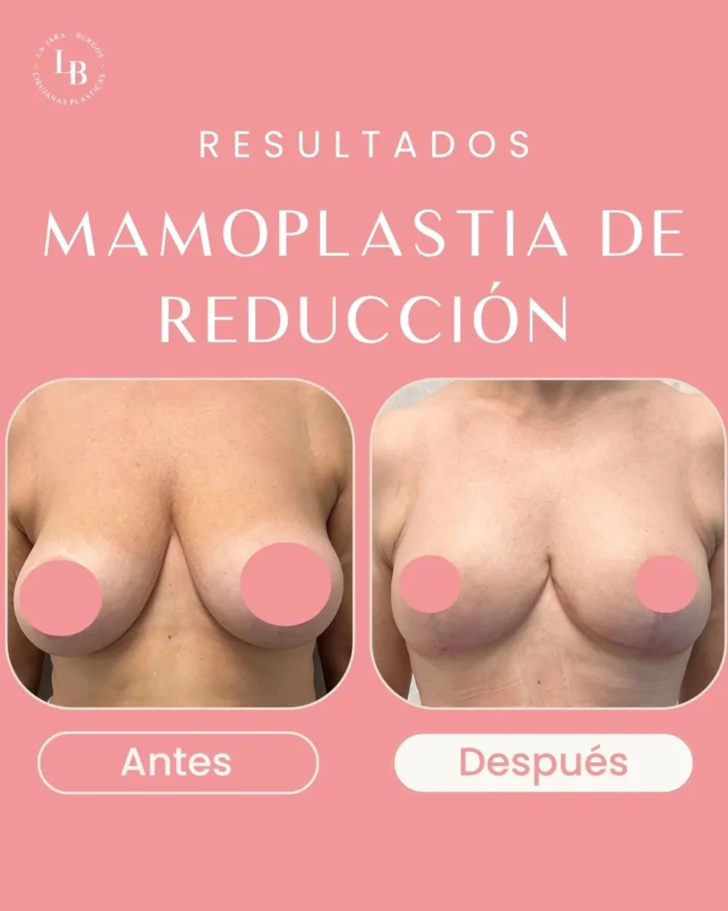 Foto del Antes de Pecho de mujer. Logo de La Jara-Burgos Cirujanas Plásticas.