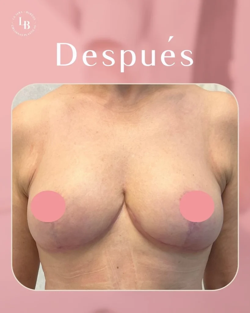 Foto del Después de reducción de Pecho de mujer. Logo de La Jara-Burgos Cirujanas Plásticas.