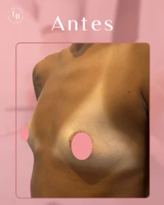 Aumento de pecho en mujer jóven. Antes y Después