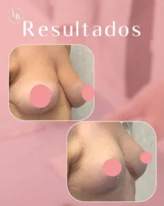 Resultados de Operación de reducción de Pecho. Fotos comparativa antes y después de la operación. Logo de La Jara-Burgos Cirujanas Plásticas.