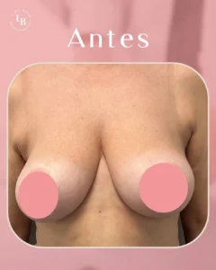 Foto del Antes de Reducción de Pecho de mujer. Logo de La Jara-Burgos Cirujanas Plásticas.