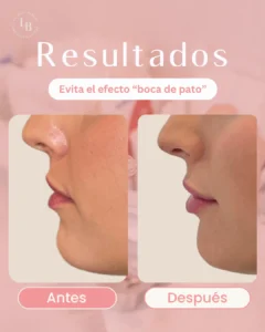 Resultados aumento de labios en paciente joven