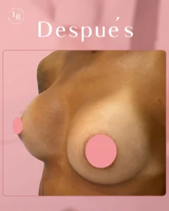 Aumento de pecho en mujer jóven. Antes y Después