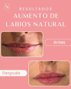 Resultados Antres y Después de aumento de labios y remodelación labial en paciente jóven