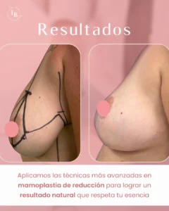 Antes y Después de paciente intervención mamoplastia de reducción. Perfil