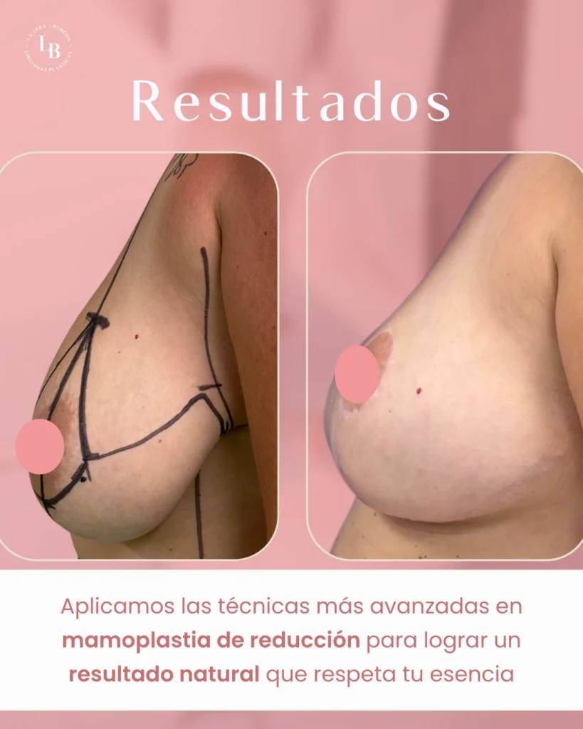 Antes y Después de paciente intervención mamoplastia de reducción. Perfil