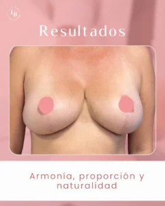 Resultados de paciente intervención mamoplastia de reducción