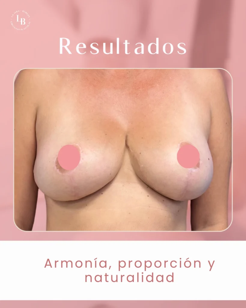 Resultados de paciente intervención mamoplastia de reducción