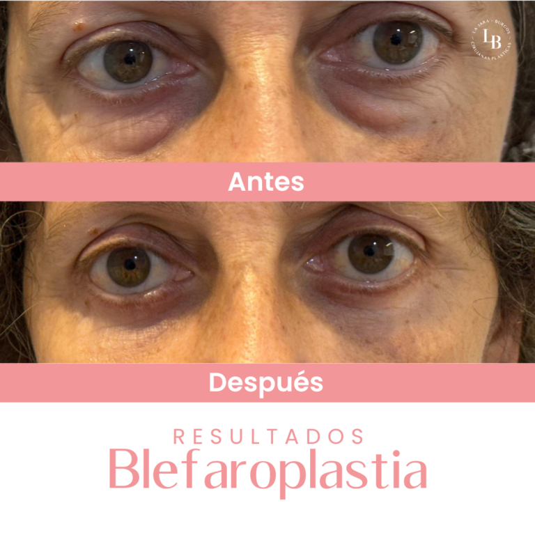 Es un ejemplo de un antes y después de blefaroplastia oviedo