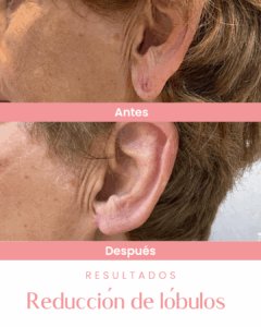 Comparación de lóbulos de una oreja antes y después de una cirugía de reducción, con texto "Resultados Reducción de lóbulos". Logo de marca La Jara - Burgos Cirujanas Plásticas