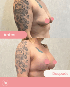 Comparación del pecho de una mujer antes y después de un aumento de senos. Cambios visibles en el tamaño. Logo de marca La Jara Burgos Cirujanas Plásticas en la esquina superior izquierda.