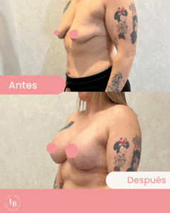 Comparación del pecho de una mujer antes y después de un aumento de senos. Cambios visibles en el tamaño. Logo de marca La Jara Burgos Cirujanas Plásticas en la esquina superior izquierda.