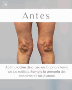 La imagen muestra un par de piernas con acumulación de grasa en la zona interna de las rodillas. El texto en la parte superior dice "Antes", indicando que esta es una imagen del estado inicial antes de la liposucción de rodillas. Hay un texto adicional en la parte inferior que explica que la acumulación de grasa rompía la armonía del contorno de las piernas.
