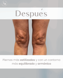 Imagen del resultado de la liposucción de rodillas: piernas con contorno más armónico y estilizado, sin cicatrices visibles.