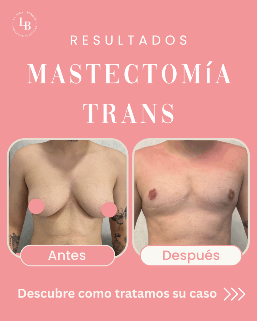 Resultados Antes y Después Mastectomía Transgénero