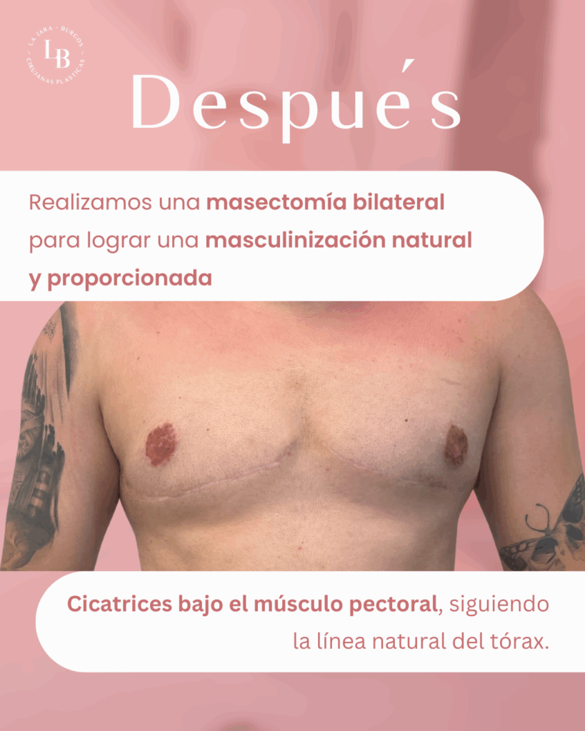 Paciente después de la operación de masculinización torácica, foto de pecho masculino.
