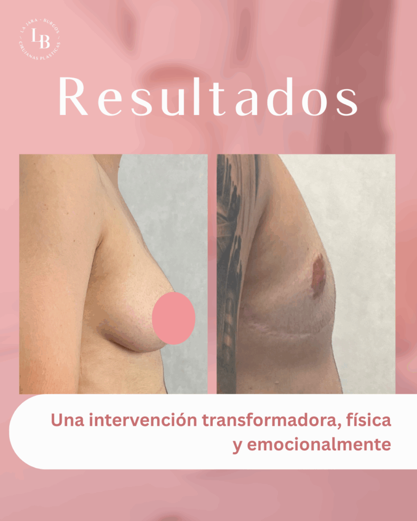Comparativa de perfil de paciente antes y después de la operación de masculinización torácica.