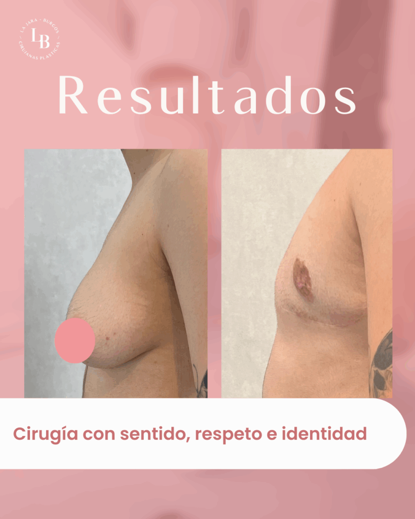 Comparativa de perfil de paciente antes y después de la operación de masculinización torácica.