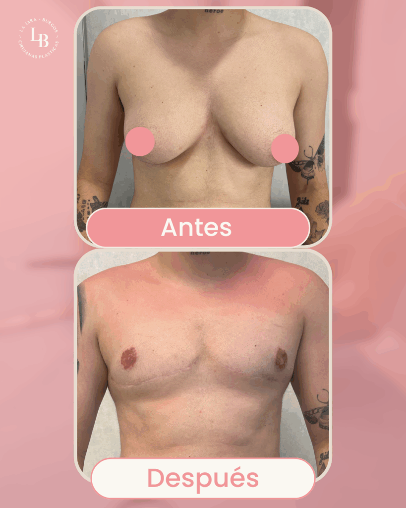 Comparativa de frente de paciente antes y después de la operación de masculinización torácica.