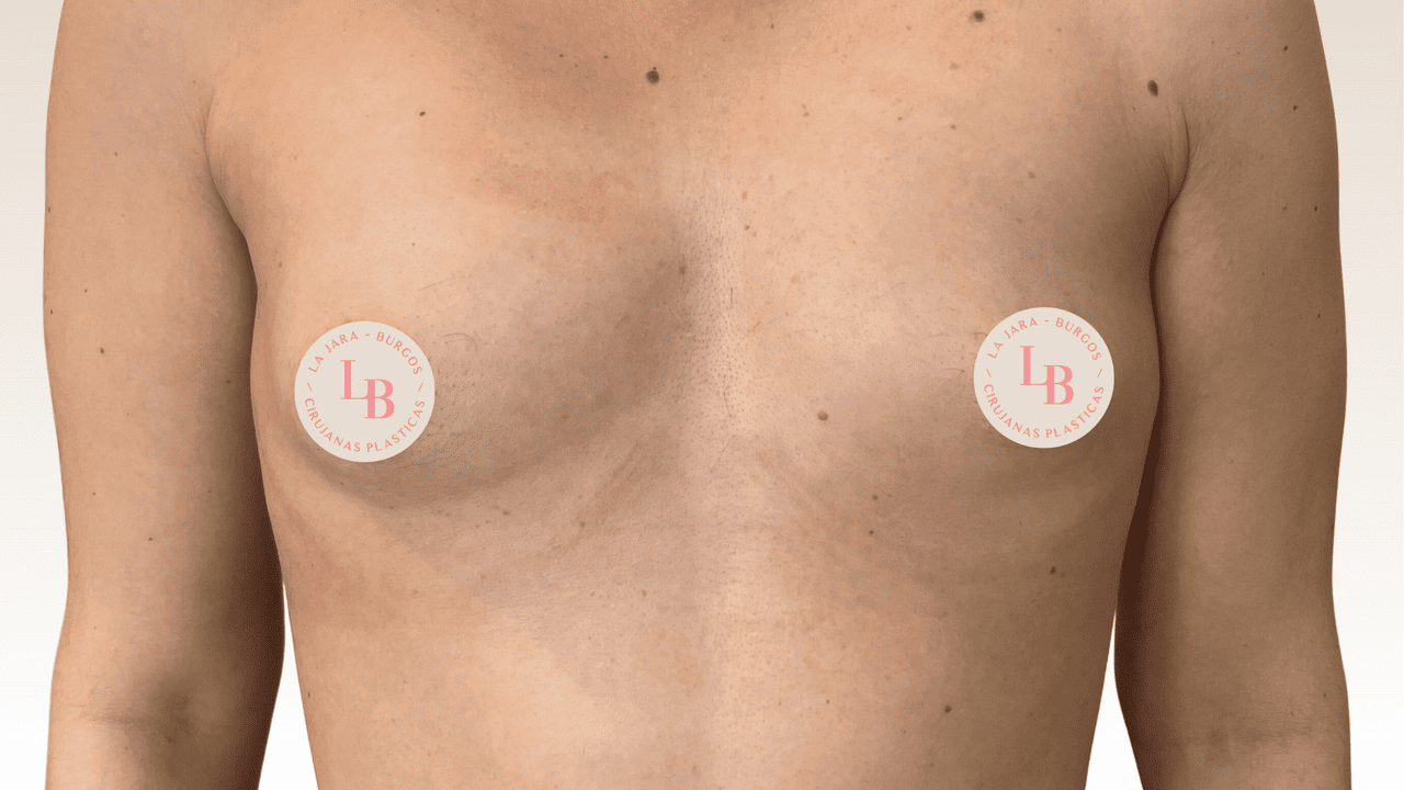 aumento mamario híbrido ANTES