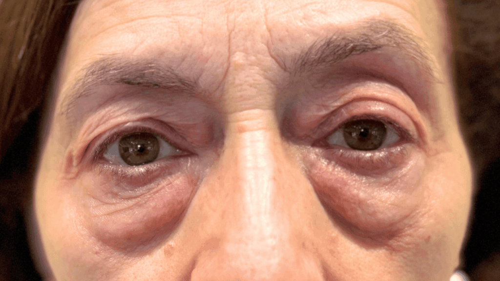 Paciente de La Jara Burgos Ciujanas Plásticas antes de someterse a cirugía de párpados o blefaroplastia completa