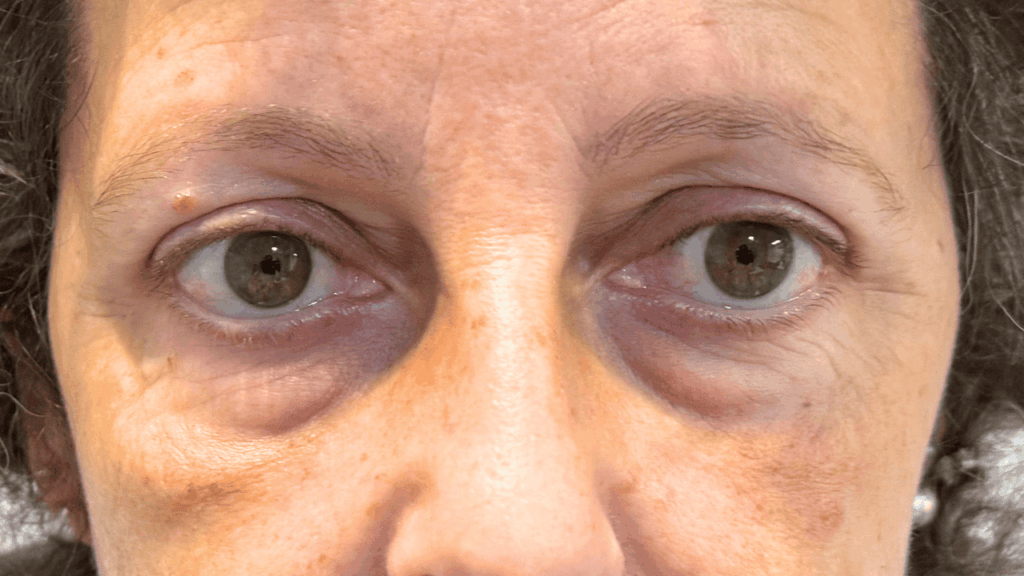 Paciente de La Jara Burgos Ciujanas Plásticas antes de someterse a cirugía de párpados o blefaroplastia inferior