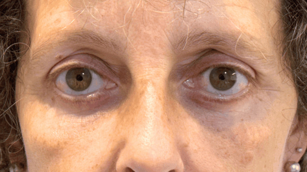 Paciente de La Jara Burgos Ciujanas Plásticas después de someterse a cirugía de párpados o blefaroplastia inferior